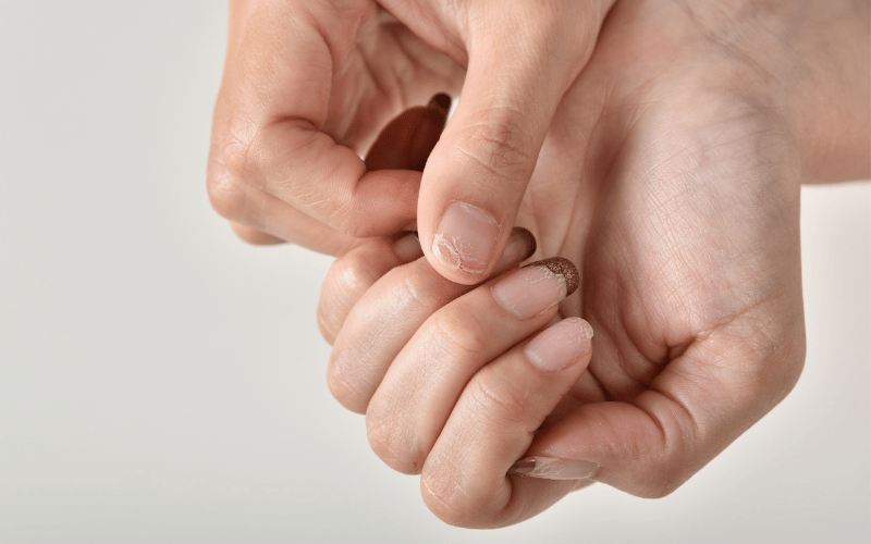 Brittle or Spoon-Shaped Fingernails- A Visual Clue