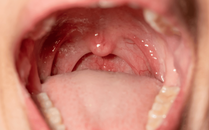 Swelling and Soreness of the Tongue and Mouth- An Unusual Indicator